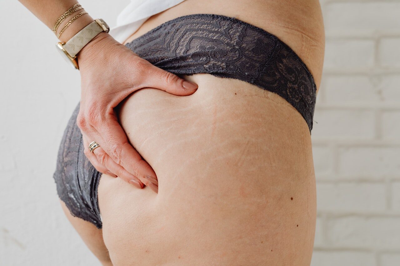 Tratamento para estrias em duque de caxias rj rosa sperandio