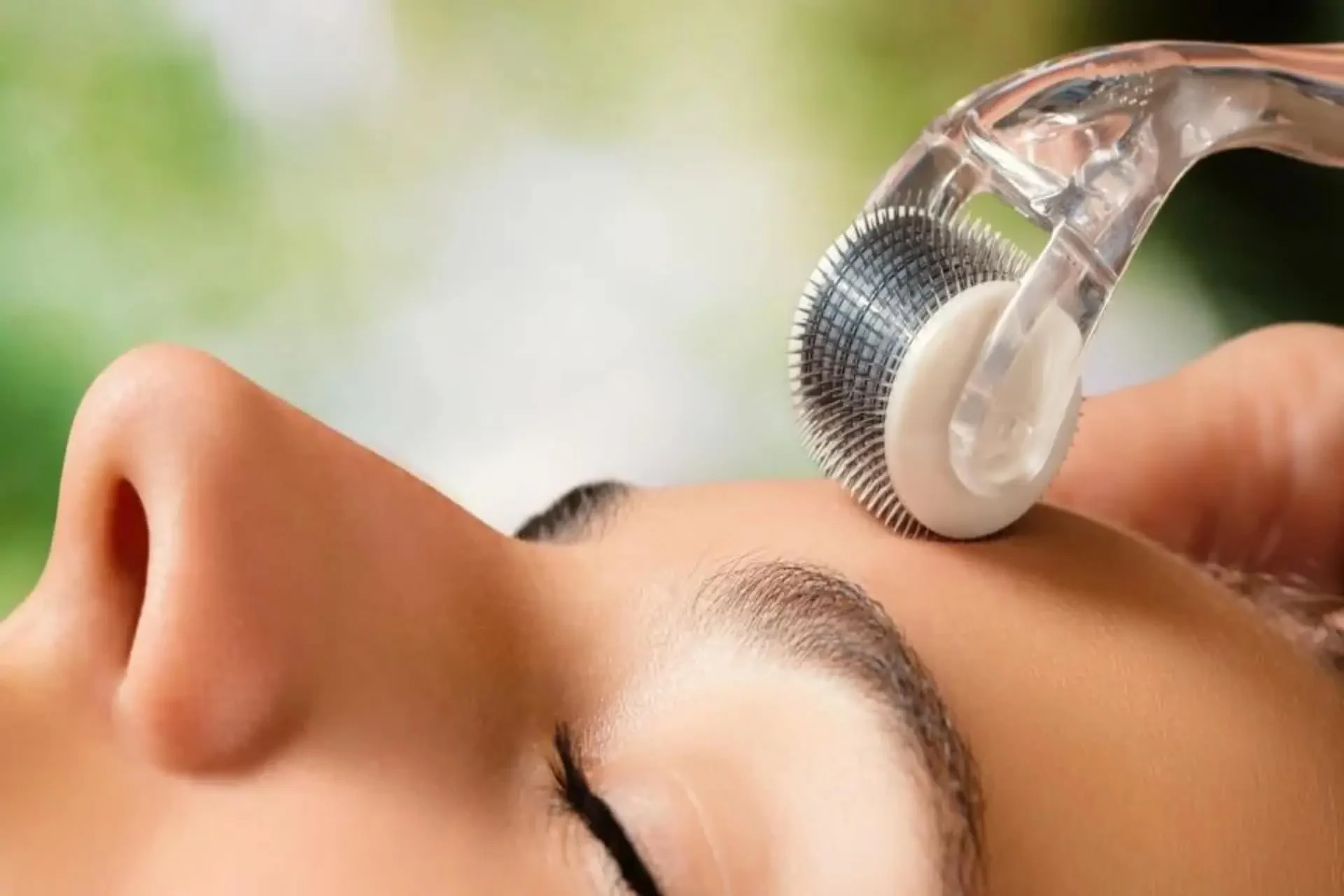 microagulhamento em duque de caxias