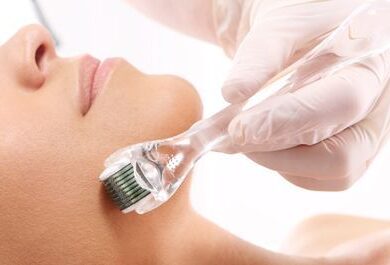 microagulhamento em duque de caxias estética Rosa Esperandio linda pele microagulhamento em duque de caxias estética Rosa Esperandio linda pele