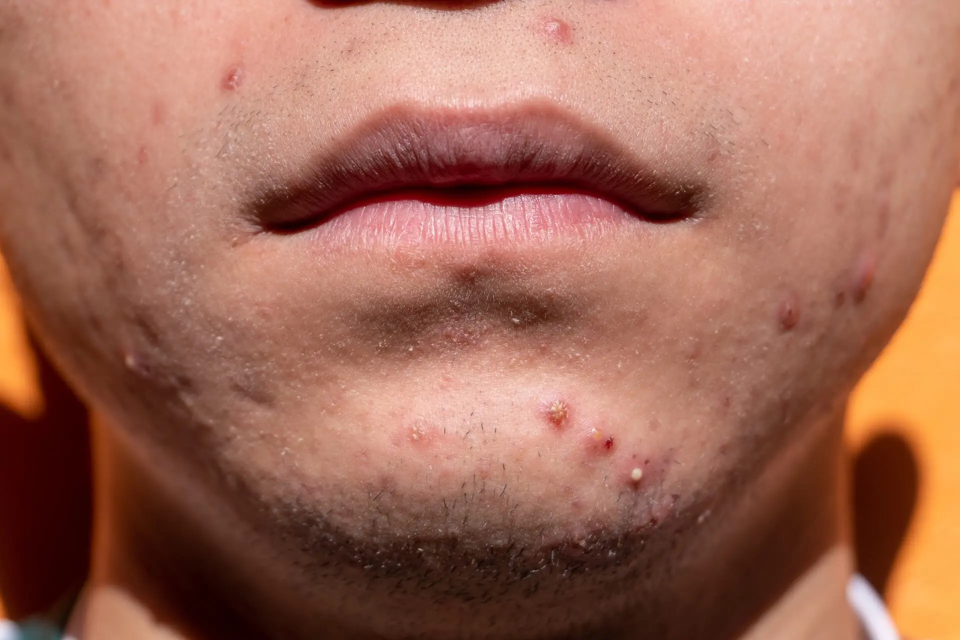 tratamento para acne em duque de caxias