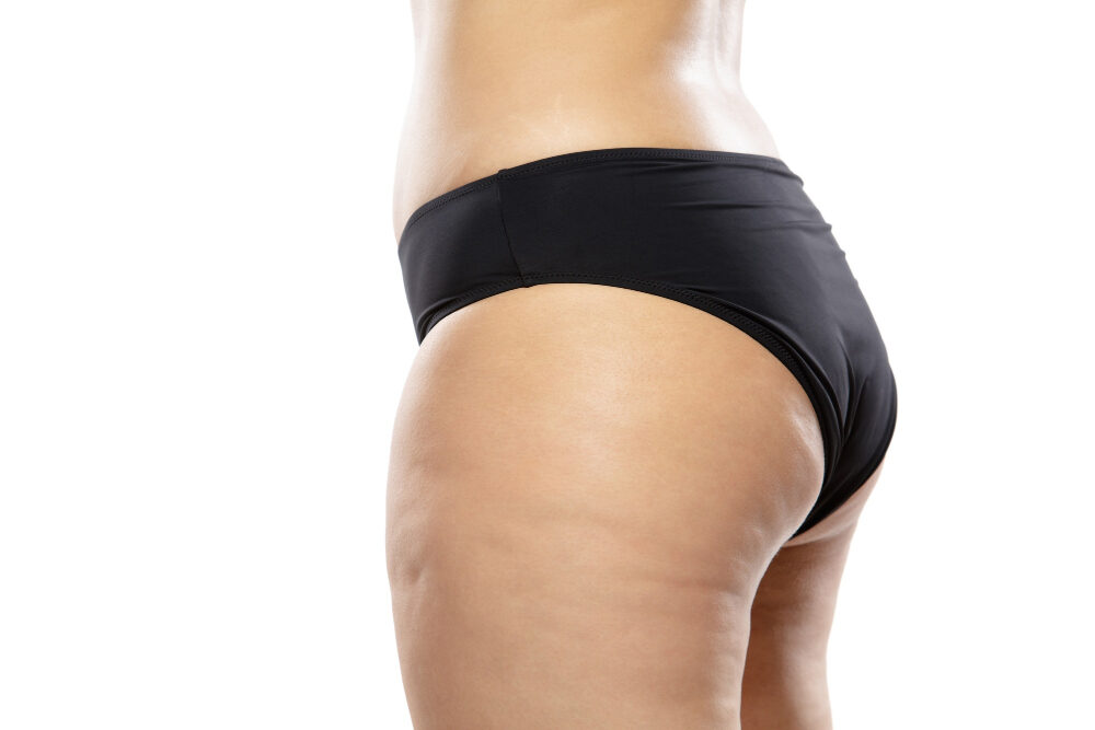 tratamento para celulite rosa sperandio duque de caxias 25 de agosto RJ