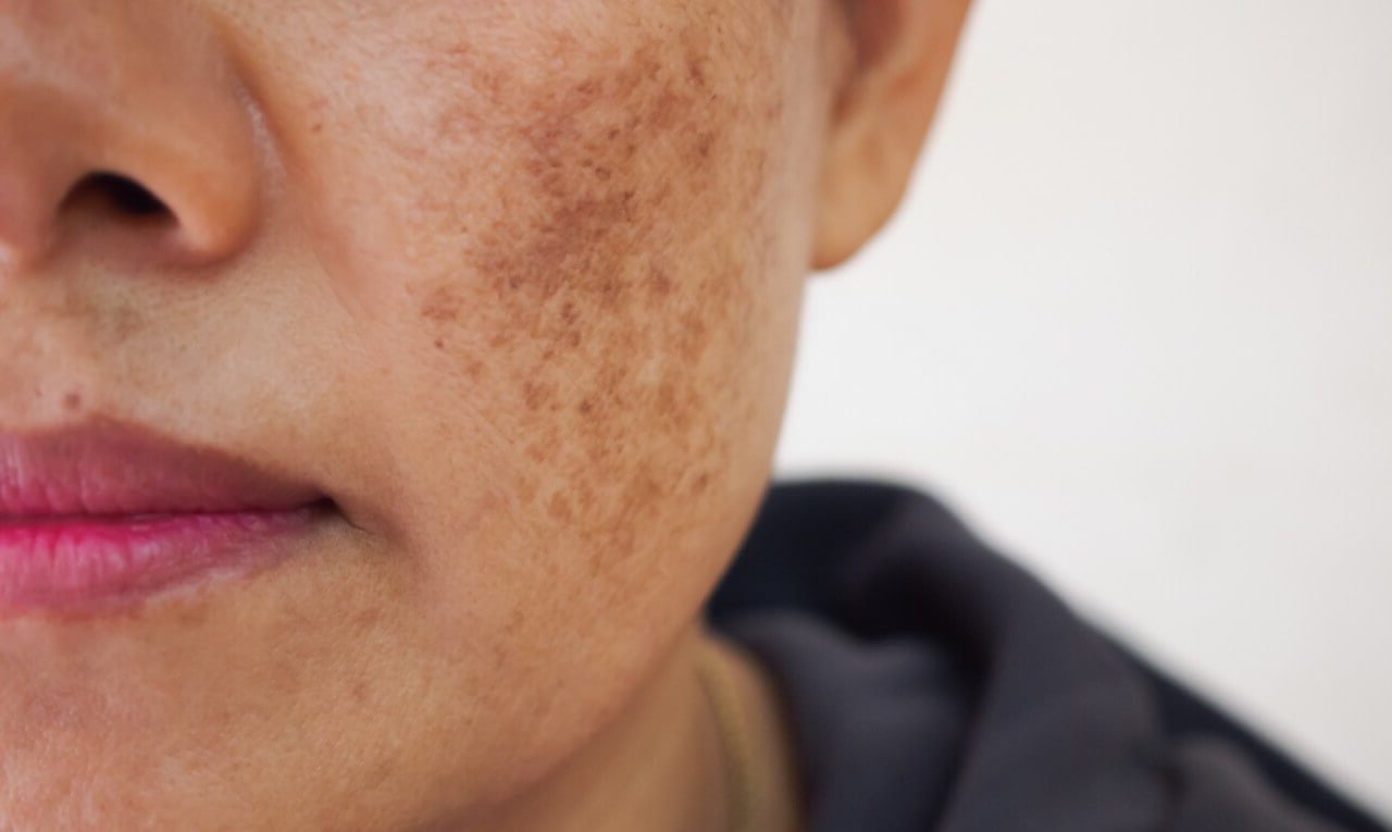Rosto de uma mulher com melasma para demonstrar o que pode ser tratado por Clareamento Facial