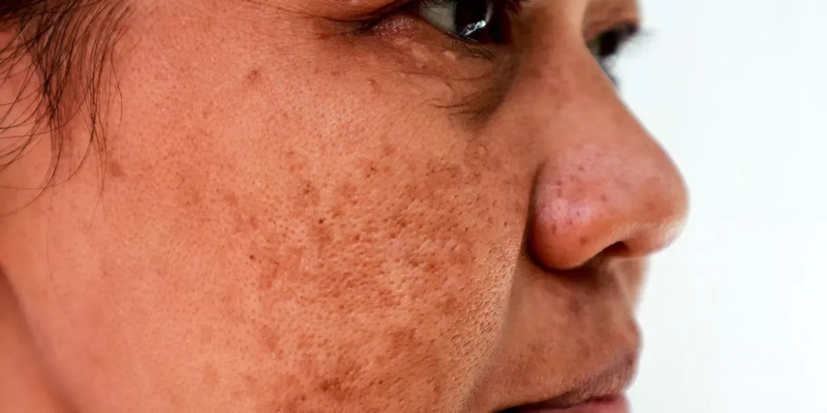 Rosto de uma senhora com manchas para demonstrar o que pode ser tratado por clareamento facial