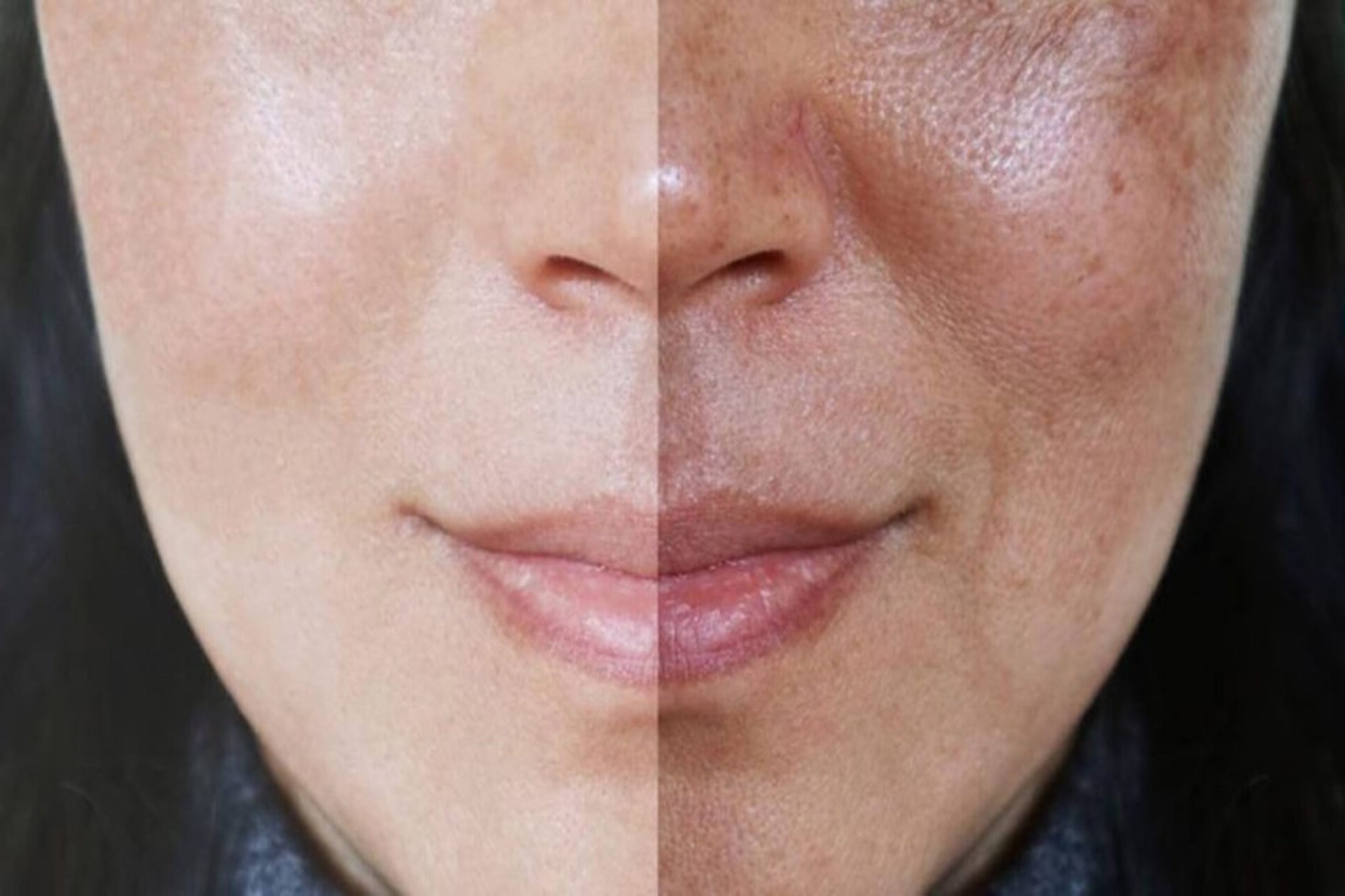 Rosto de uma mulher em coparação quando se passa por um procedimento de clareamento facial