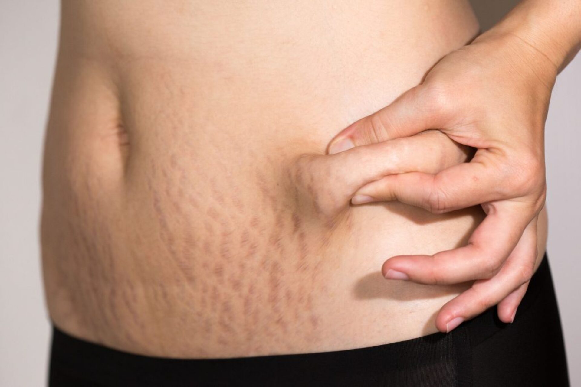 Tratamento para estrias em duque de caxias rj bairro 25 de agosto DC