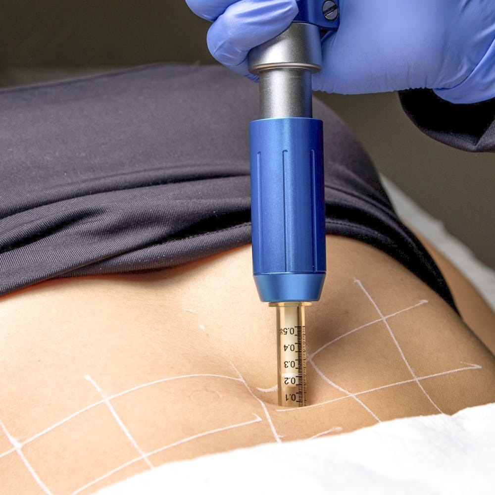 Mulher recebendo tratamento de harmonização corporal em duque de Caxias, na barriga